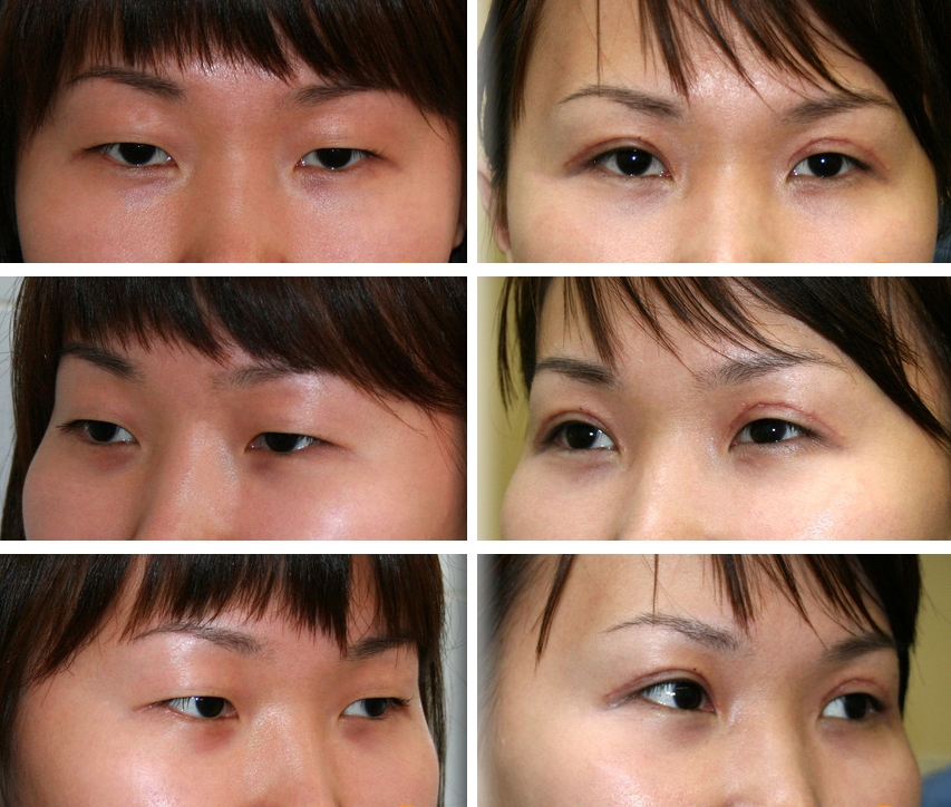 Что такое сангапури для глаз в косметологии. Эпикантус операция. Сангапури эпикантус. Пластика азиатских век европеизация глаз. Нитевая блефаропластика век сангапури.
