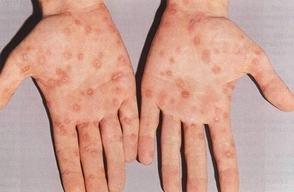 Сыпь на теле. Как отличить инфекцию от аллергии?