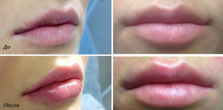 Увлажнение губ до и после. Фракционная мезотерапия губ. Увлажнение губ гиалуроновой кислотой. Мезотерапия губ гиалуроновой кислотой.